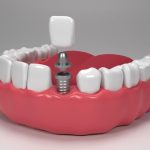 How Long Do Dental Implants Actually Last?